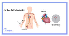 چرا کاتتریزاسیون قلبی انجام می شود؟