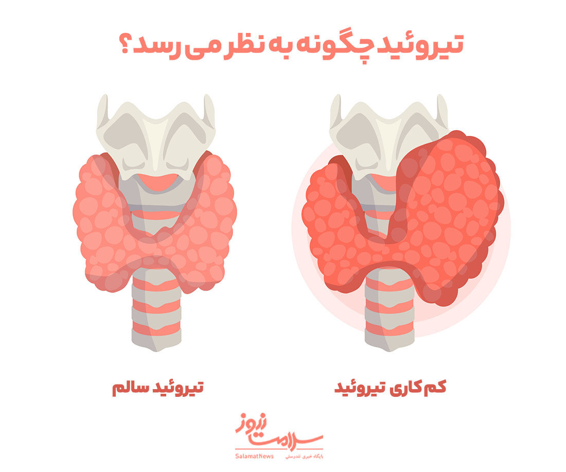 کم کاری تیروئید
