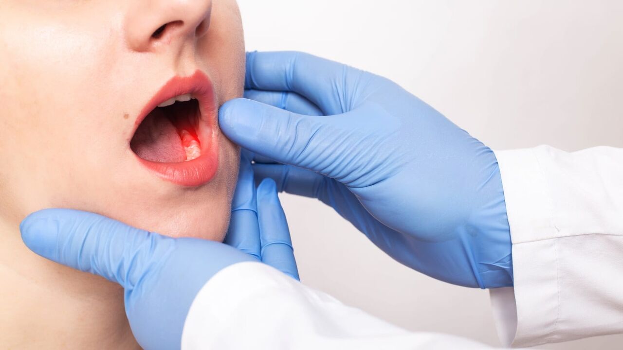 علائم شایع سرطان دهان علائم شایع سرطان دهان