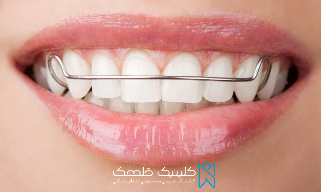جدیدترین روش های درمان با انجام ارتودنسی دندان