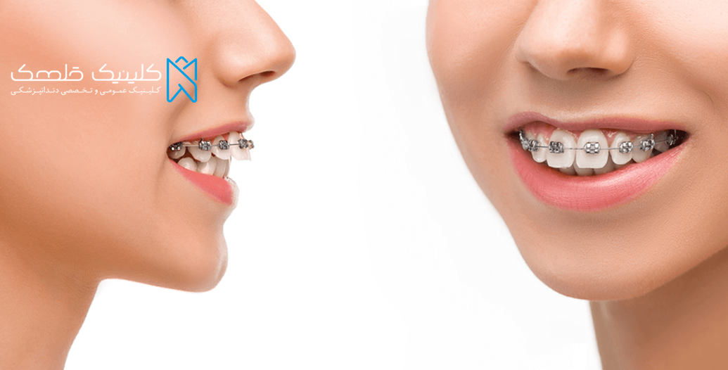 جدیدترین روش های درمان با انجام ارتودنسی دندان