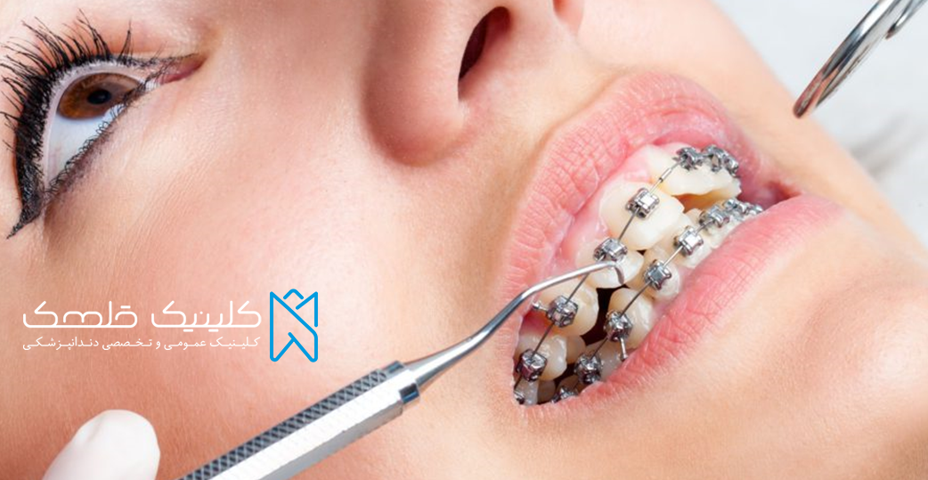 جدیدترین روش های درمان با انجام ارتودنسی دندان 