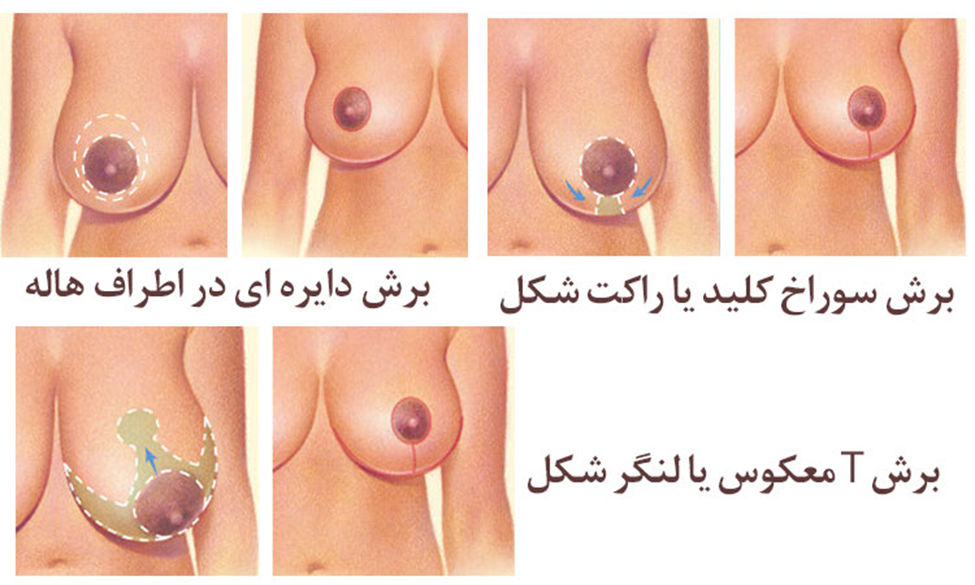 کوچک کردن سینه به کمک عمل ماموپلاستی