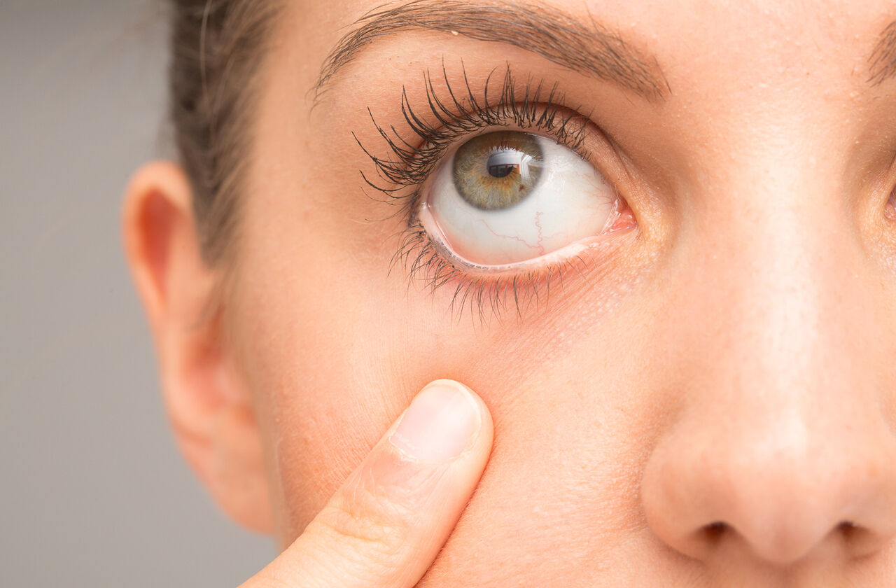 چه زمانی برای خشکی چشم به پزشک مراجعه کنید؟