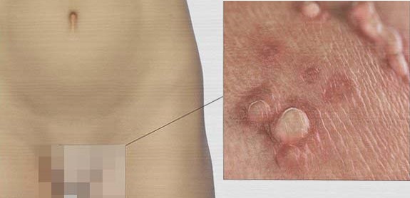 برداشت زگیل تناسلی با لیزر مزایا، معایب و عوارض