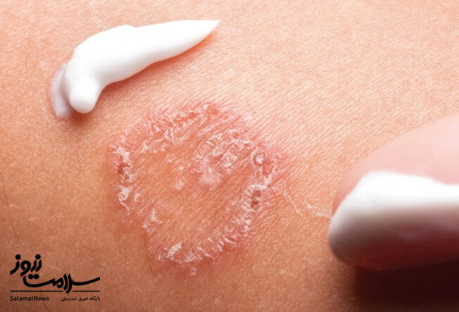 عفونت های پوستی: آنچه لازم است بدانید!