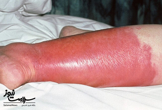 عفونت های پوستی: آنچه لازم است بدانید!