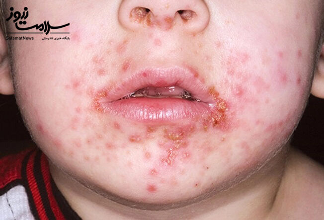 عفونت های پوستی: آنچه لازم است بدانید!