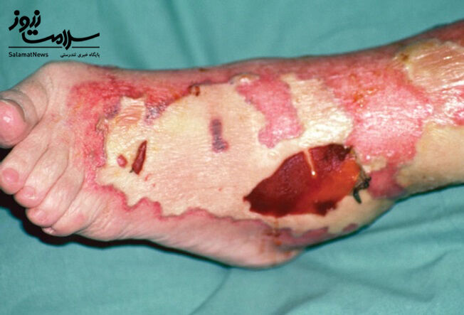 عفونت های پوستی: آنچه لازم است بدانید!