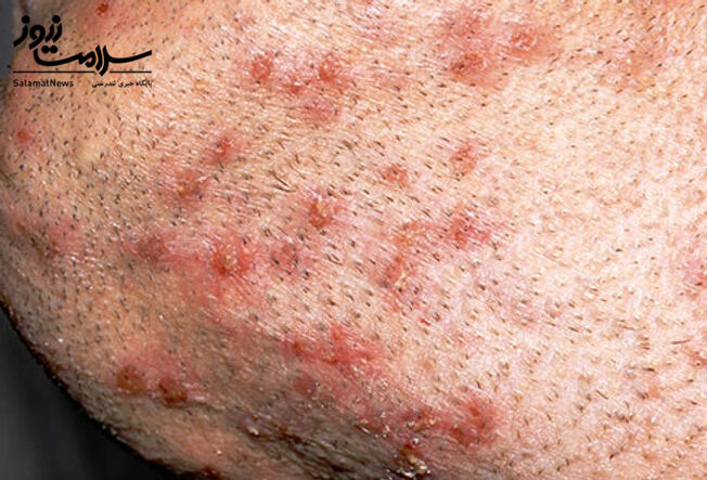 عفونت های پوستی: آنچه لازم است بدانید!
