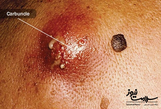 عفونت های پوستی: آنچه لازم است بدانید!