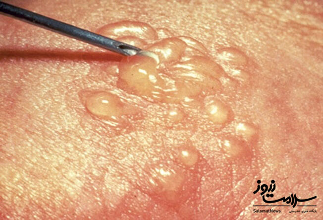 عفونت های پوستی: آنچه لازم است بدانید!