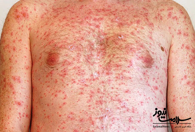 عفونت های پوستی: آنچه لازم است بدانید!