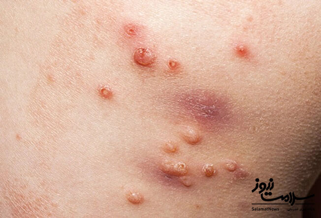 عفونت های پوستی: آنچه لازم است بدانید!