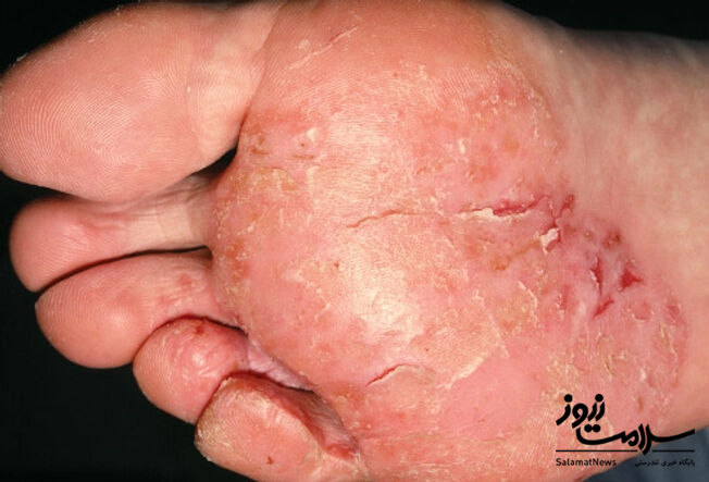 عفونت های پوستی: آنچه لازم است بدانید!