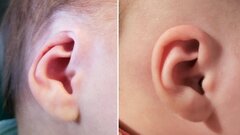 درمان ناهنجاری گوش نوزاد با گیره کاغذ