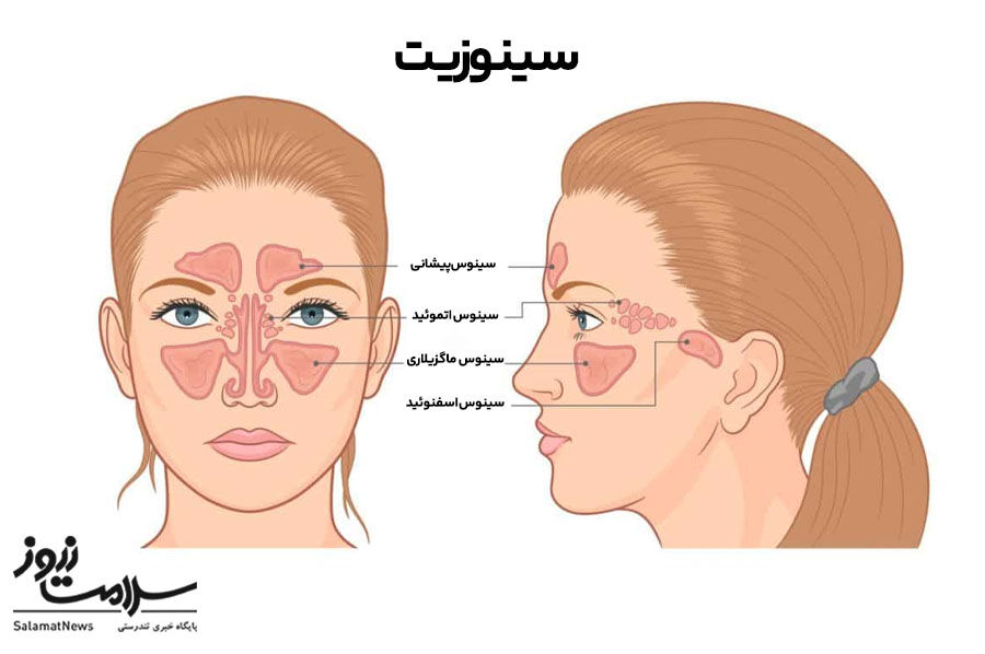انواع سردرد و روش های درمانی آن