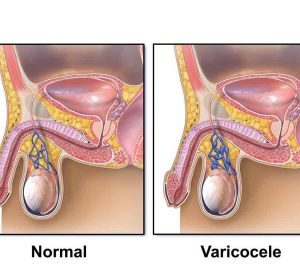 عمل واریکوسلتومی از علت تا مراقبت های پس از آن
