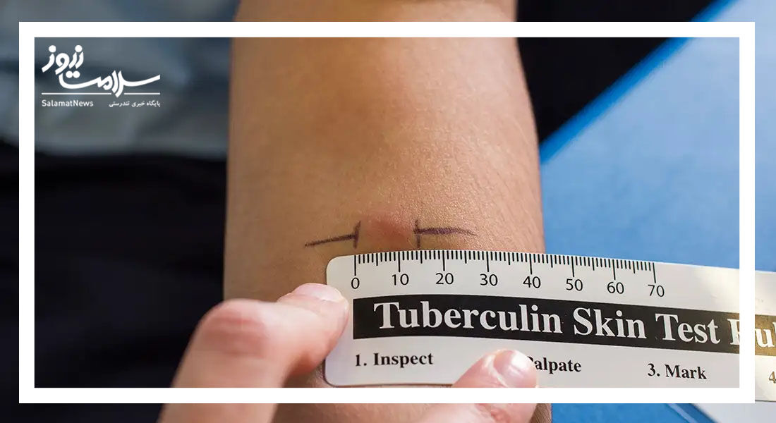 تست سِل (TB) چگونه انجام می شود؟ تست سِل (TB) چگونه انجام می شود؟
