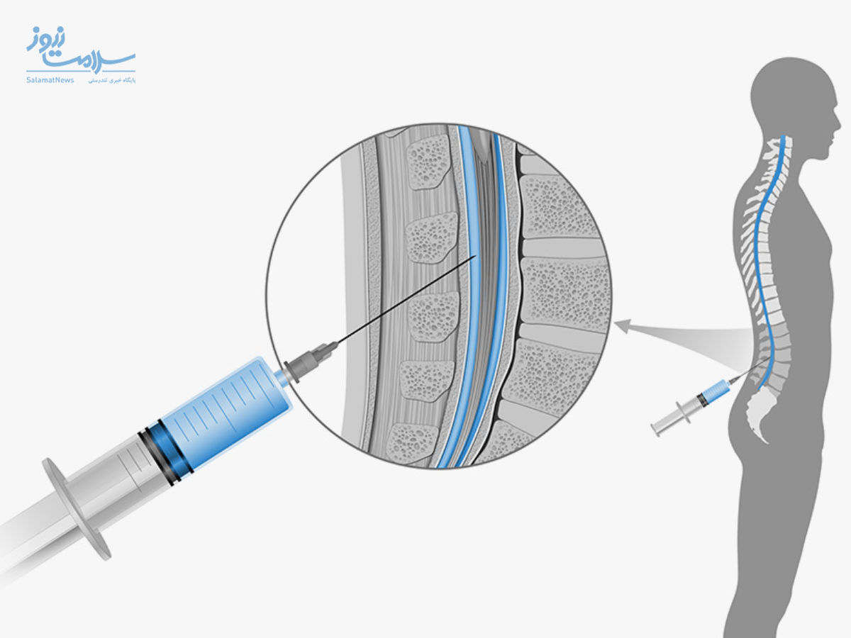 میلوگرام چیست و چرا انجام می شود؟