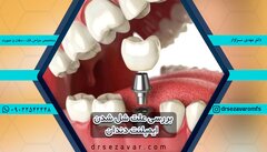 علت شل شدن ایمپلنت دندان و درمان آن