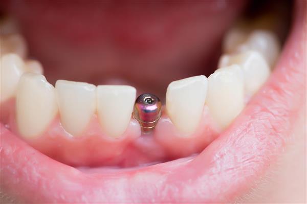 دندانپزشکی با بیهوشی چگونه انجام می‌شود؟