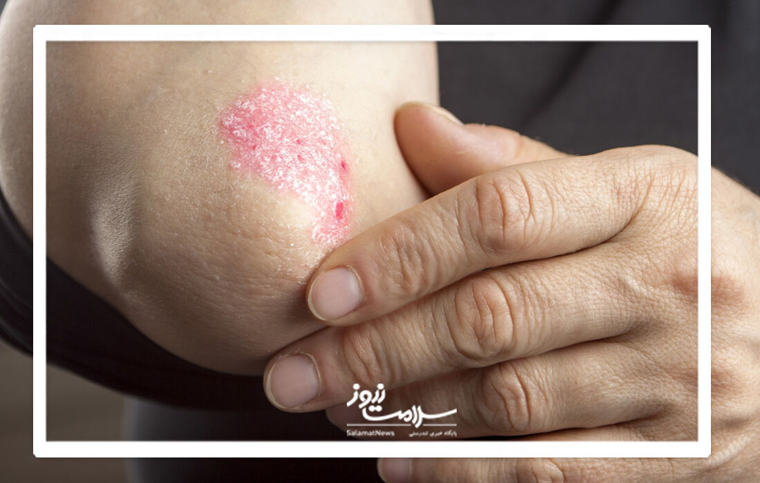 نشانه های پسوریازیس و راه های درمان آن