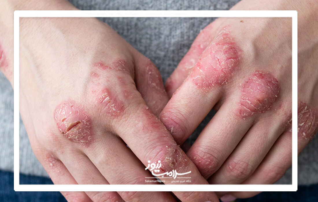 نشانه های پسوریازیس و راه های درمان آن
