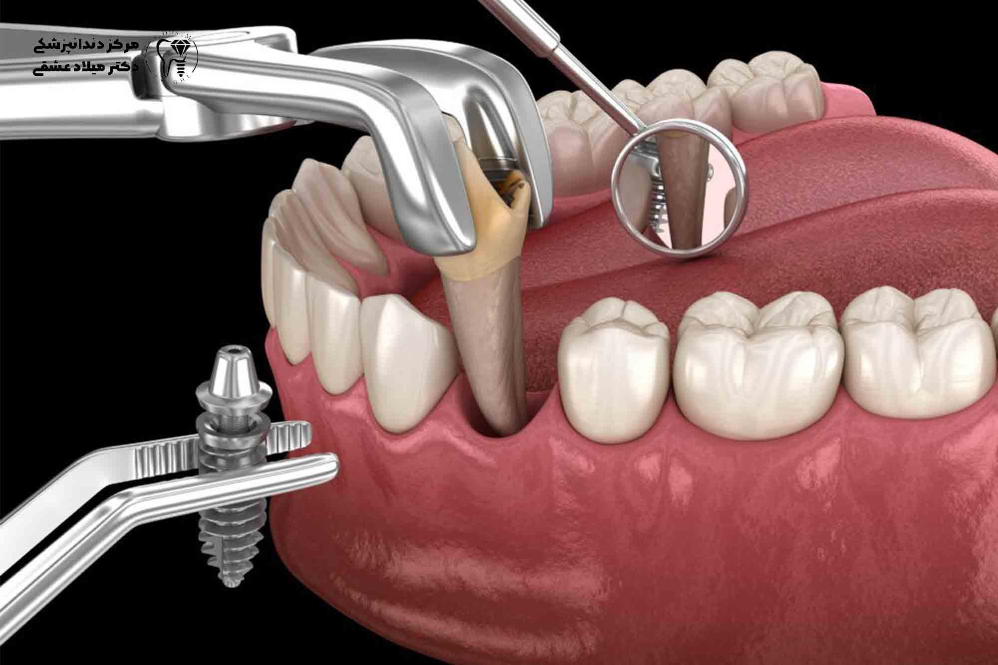 آیا همزمان با کشیدن دندان، میتوان آن را با ایمپلنت دندان جایگزین کرد؟