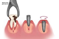 آیا همزمان با کشیدن دندان، میتوان آن را با ایمپلنت دندان جایگزین کرد؟