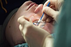 جراحی لیزیک برای اصلاح بینایی چه کسانی مناسب نیست؟