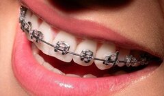 ارتودنسی کردن دندان چه خاصیتی دارد؟
