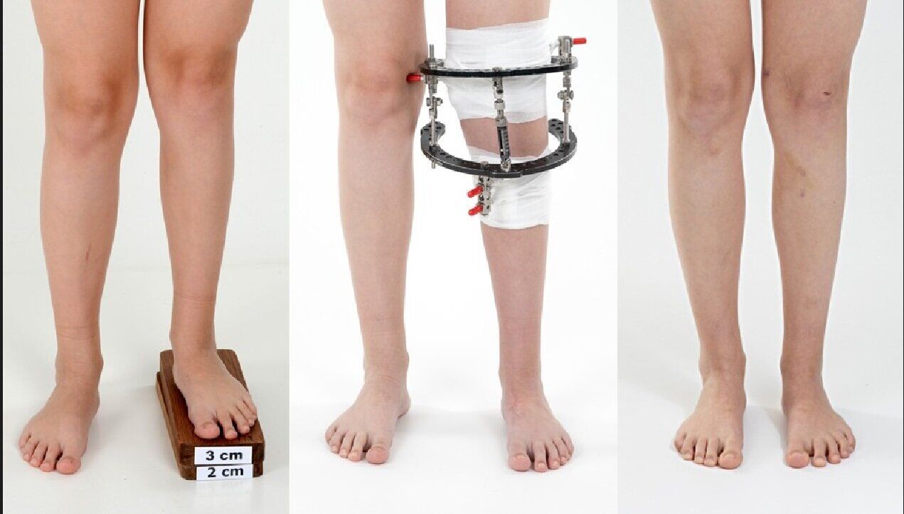 محبوبیت جراحی افزایش قد در مردان