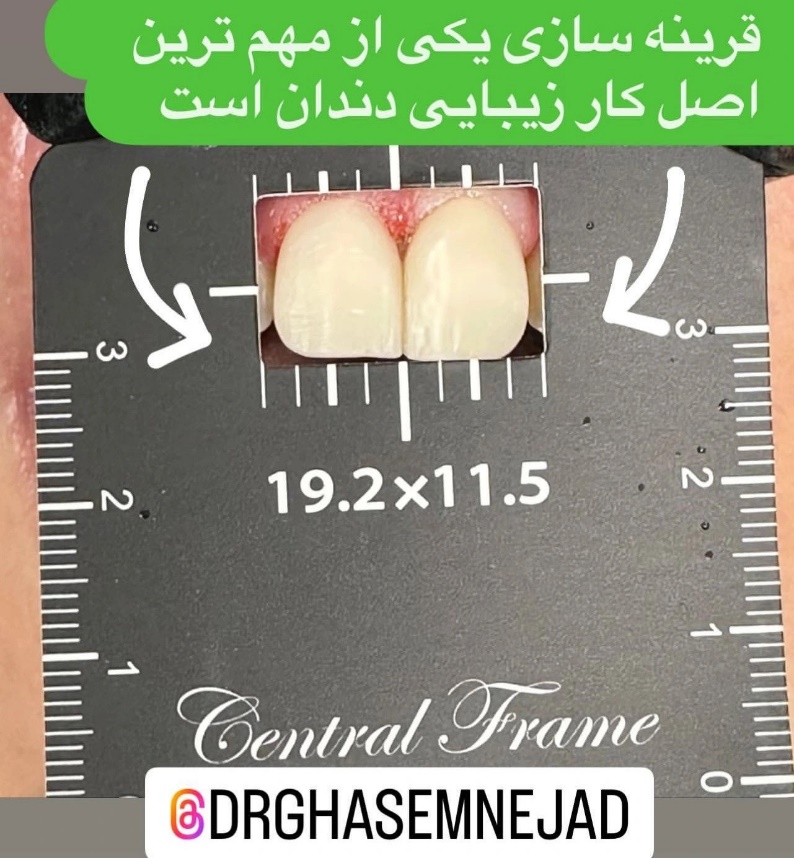 فرق کامپوزیت و لمینت  به زبان ساده