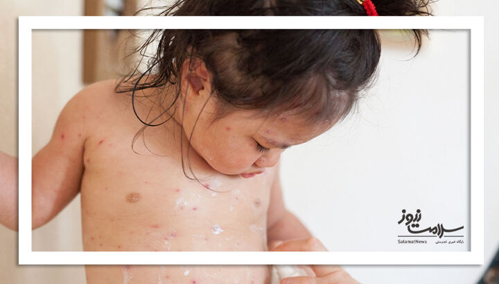 راهکارهای ساده برای تسکین علائم آبله مرغان راهکارهای ساده برای تسکین علائم آبله مرغان