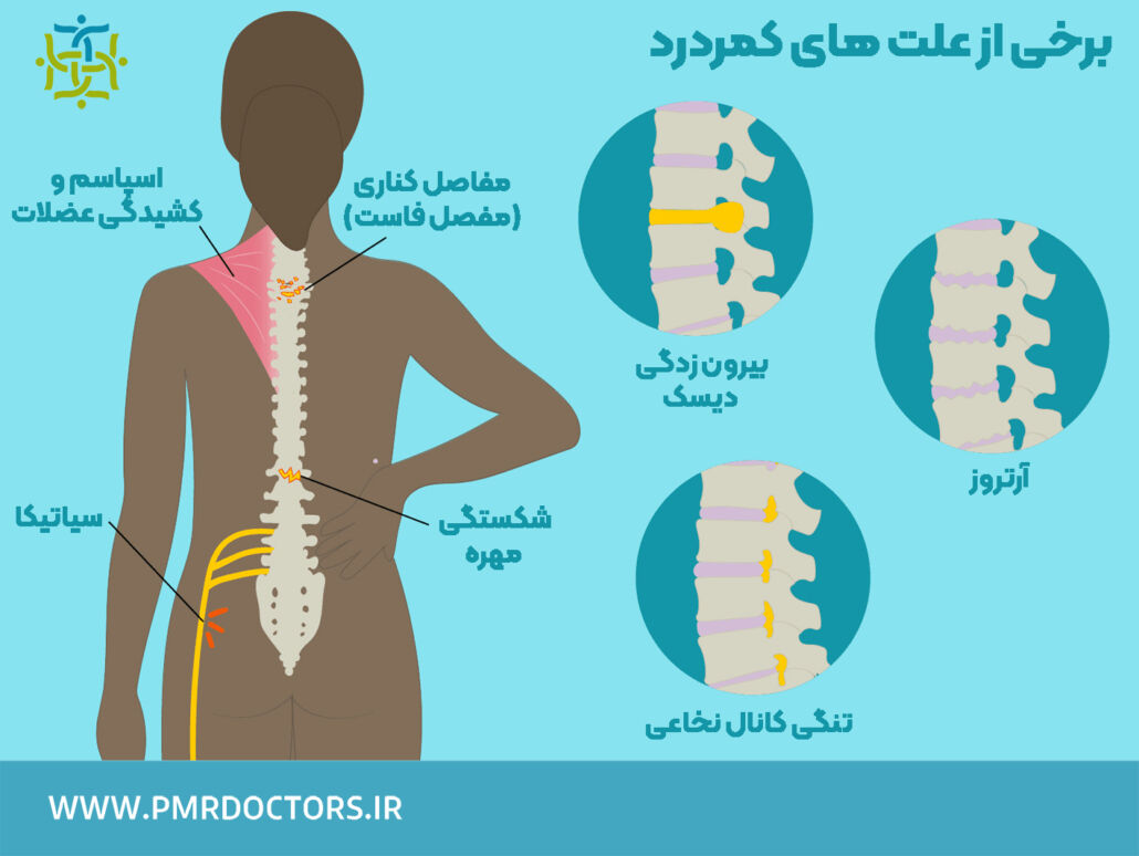 متخصص کمر درد، دیسک کمر و سیاتیک! به چه دکتری باید مراجعه کنیم ؟