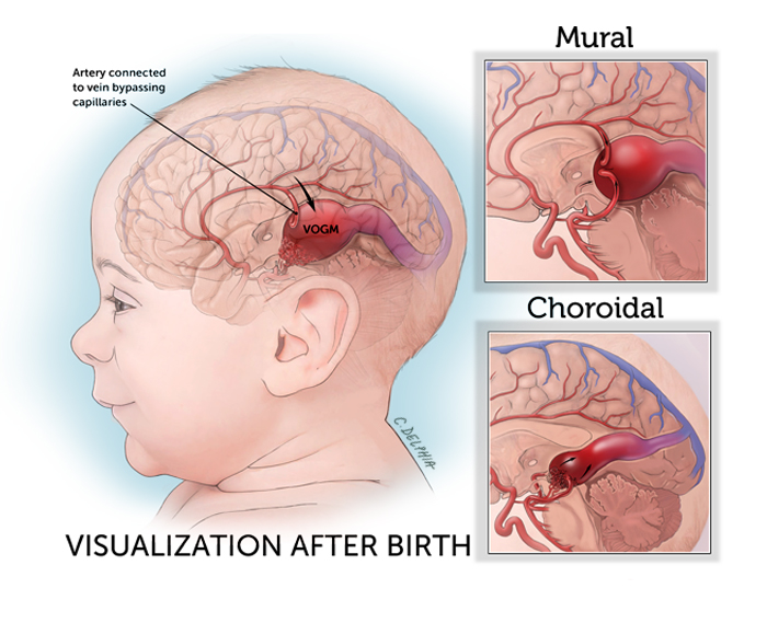 اولین جراحی مغز از درون رحم بر روی جنین با موفقیت انجام شد