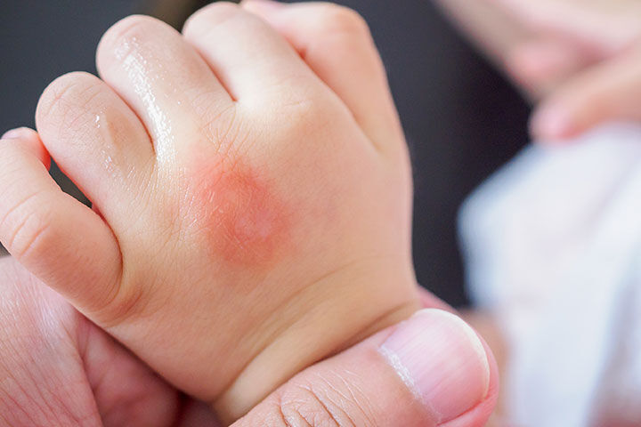 چه عواملی باعث ایجاد آلرژی در کودکان می‌شوند؟