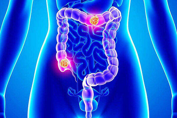 اینفوگرافیک / تشخیص زودهنگام سرطان روده با پنج علامت