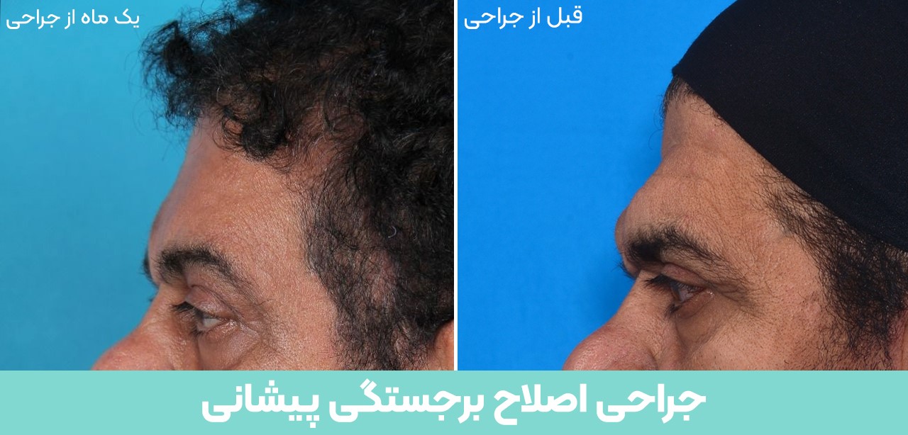 پیشانی برجسته یا پیشانی نئادرتال چیست ؟
