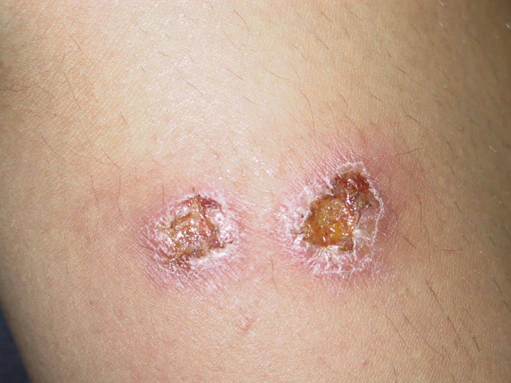 تولید منحصربه فردترین داروی درمان «سالَک» توسط محققان ایرانی تولید منحصربه فردترین داروی درمان «سالَک» توسط محققان ایرانی