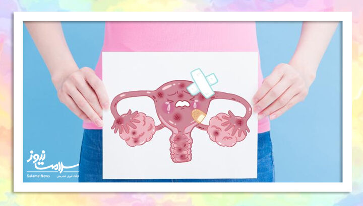 نفخ مداوم میتواند نشانهای از سرطان تخمدان باشد نفخ مداوم میتواند نشانهای از سرطان تخمدان باشد