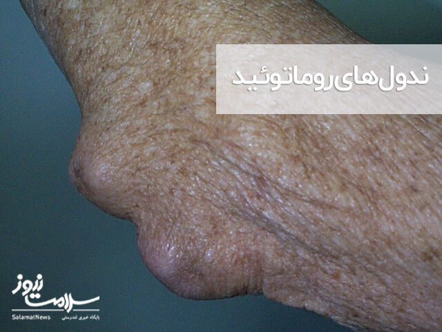 ندول روماتوئید