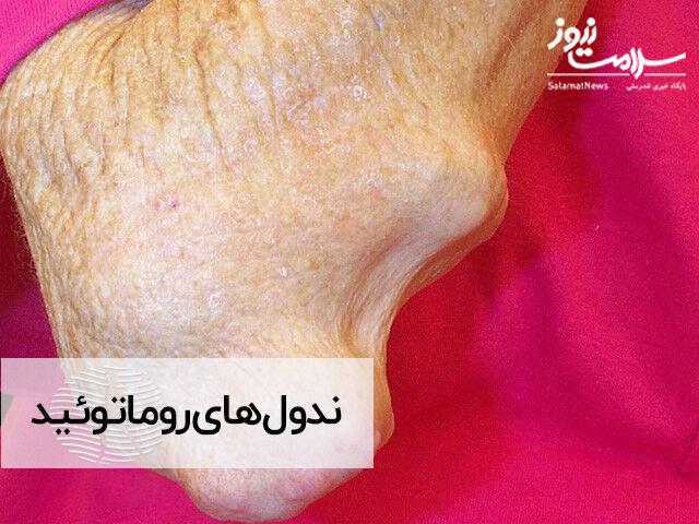 ندول روماتوئید