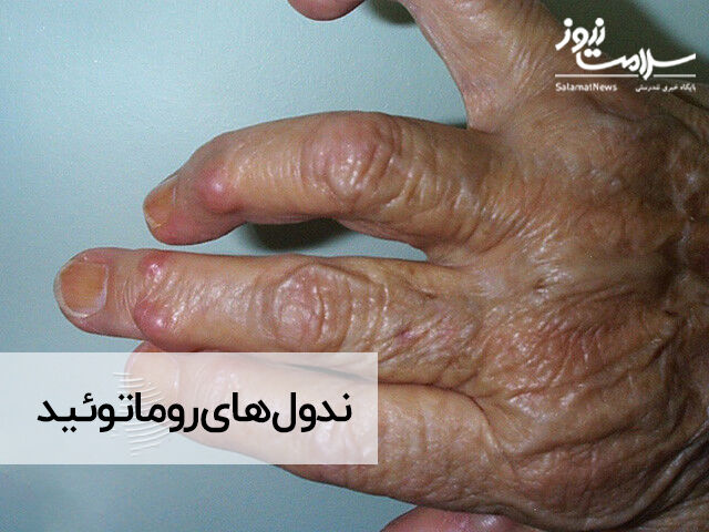 ندول روماتوئید