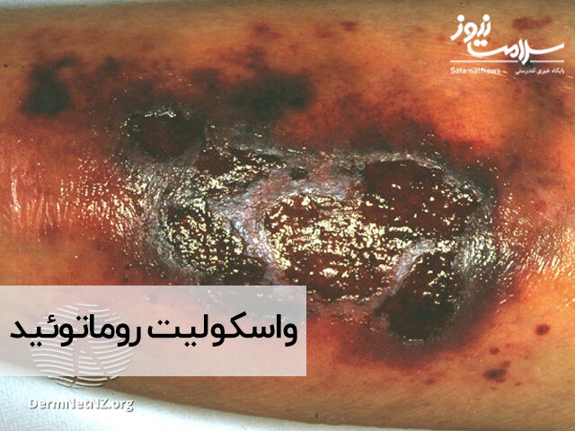 واسکولیت روماتوئید