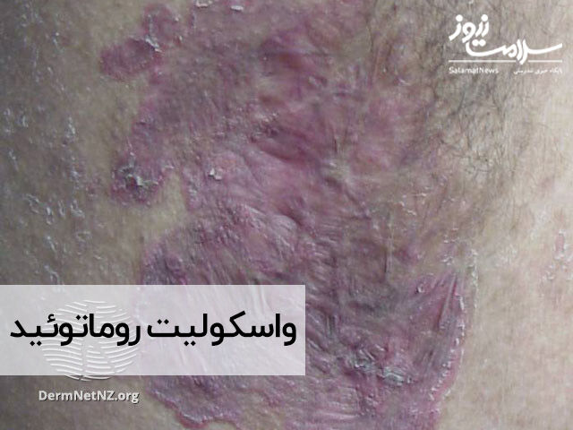 واسکولیت روماتوئید