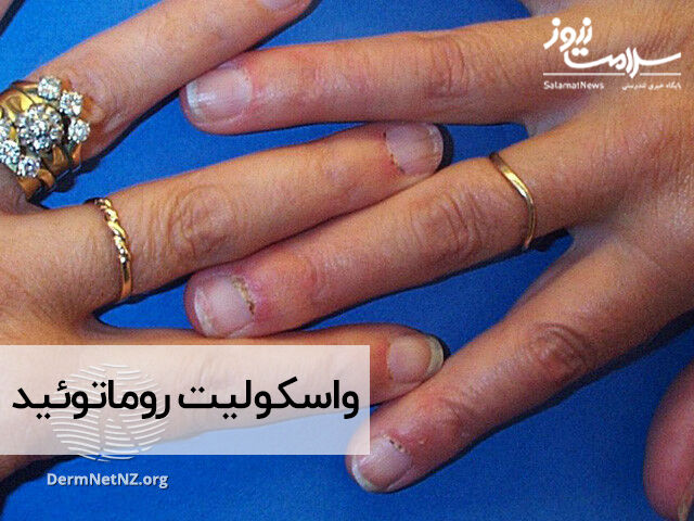 واسکولیت روماتوئید