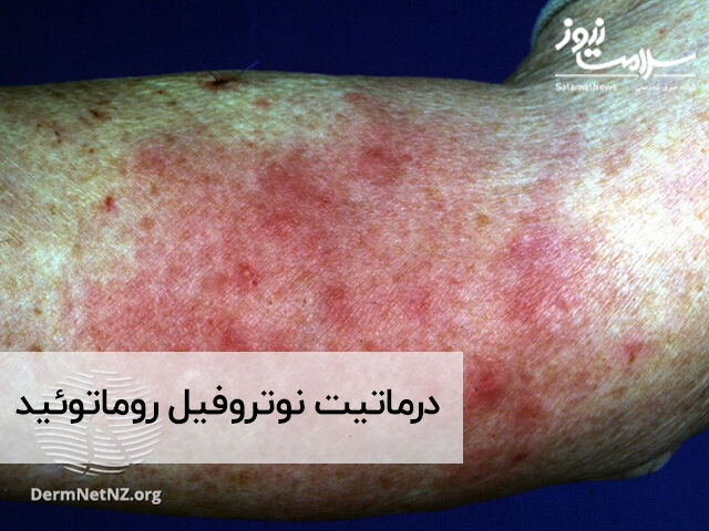 درماتیت نوتروفیل روماتوئید