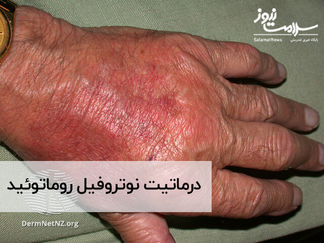 درماتیت نوتروفیل روماتوئید